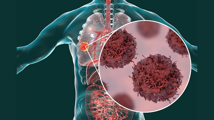 What Is Cancer And What Causes It? Diet, Toxins, Stress