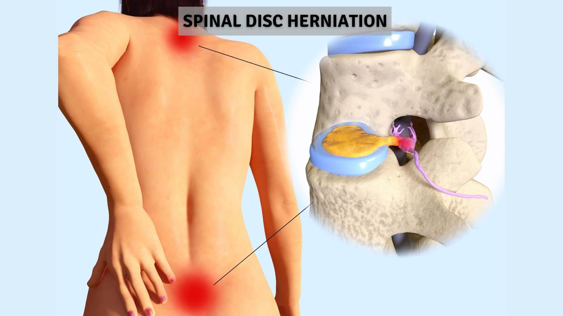 Ozone Therapy for Spinal Disc Herniations..